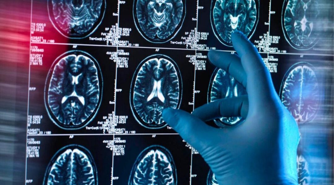 Alzheimer : Le Sommeil Profond, un Bouclier Cérébral Naturel selon une Étude