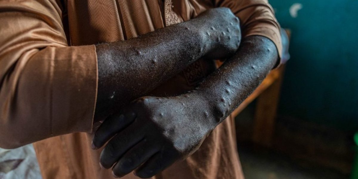 Deux nouveaux cas de Mpox confirmés à La Réunion : l'ARS active la vaccination préventive