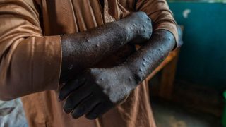 Deux nouveaux cas de Mpox confirmés à La Réunion : l'ARS active la vaccination préventive